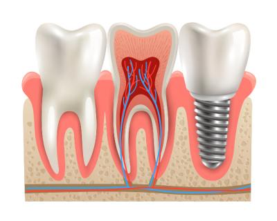 implant dentaire nanterre