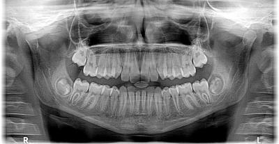panoramique dentaire - dentiste nanterre